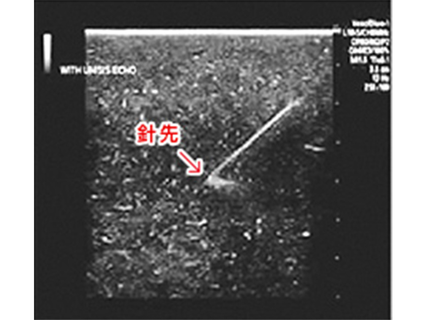 超音波画像下での穿刺映像