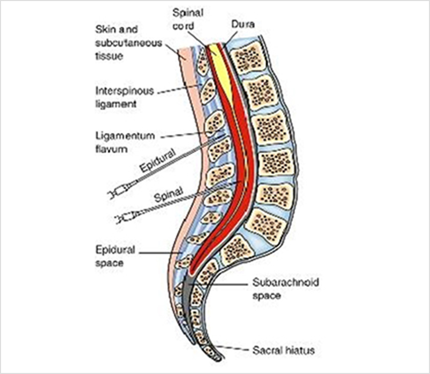 用法：硬膜外麻酔の適用