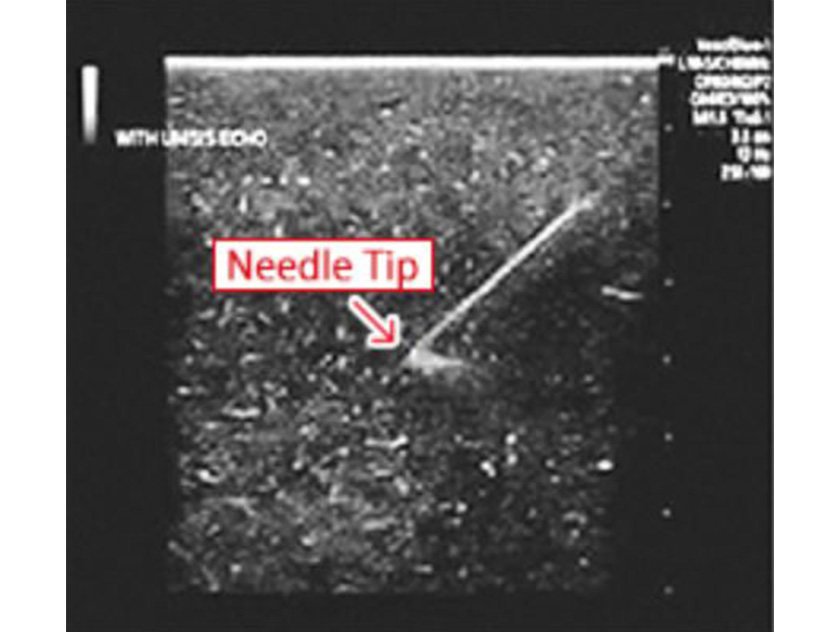 Puncture image under ultrasound image