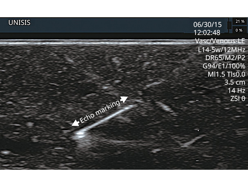 Echo image of 22G Nerve Blockade Needle with Huber point (Echogenic) inside blue Phantom