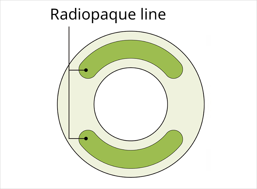 Easy detection (Radiopaque line)